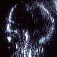 fetal scan