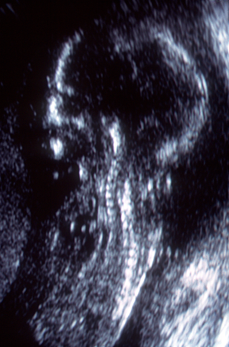 fetal scan
